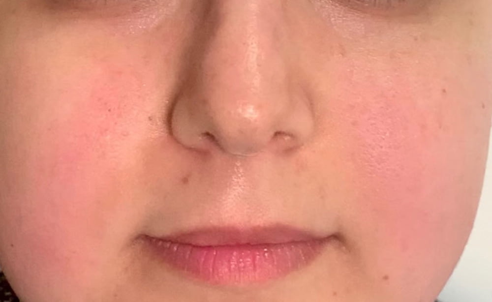 Hydrafacial Après